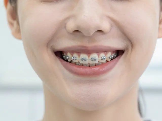 5 mýtů o keramických rovnátkách: Pravda o neviditelném rovnání zubů