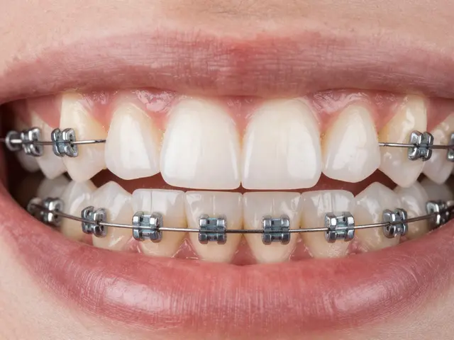 Keramická rovnátka: Výhody, nevýhody a co vás čeká při léčbě